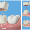 Dental Bridges and Crown Facts 2021